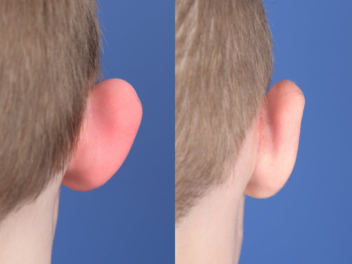 Otoplasty Before & After Gallery - Patient 521956 - Image 8
