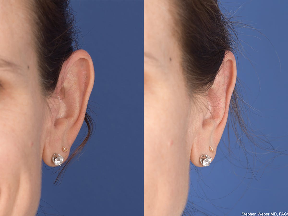 Otoplasty Before & After Gallery - Patient 315687 - Image 1
