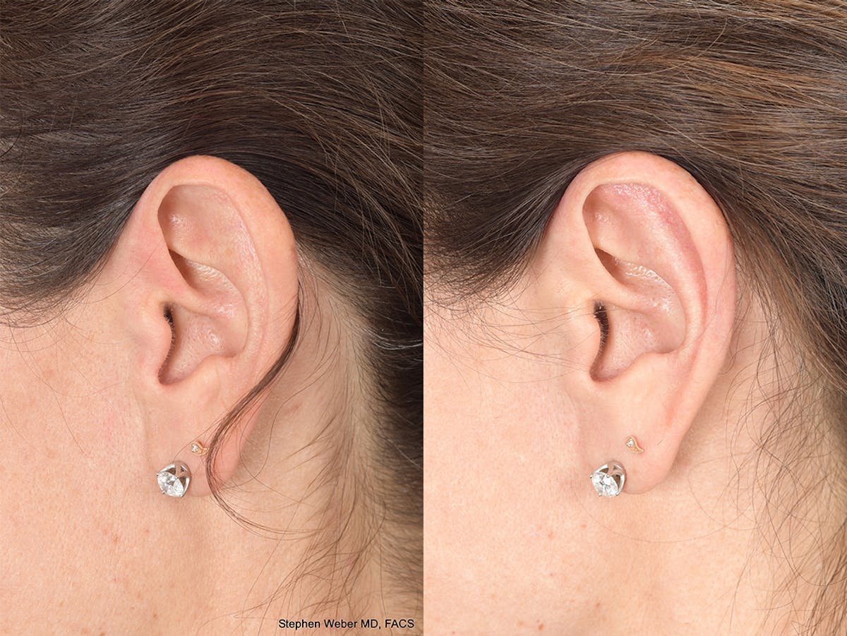Otoplasty Before & After Gallery - Patient 315687 - Image 2