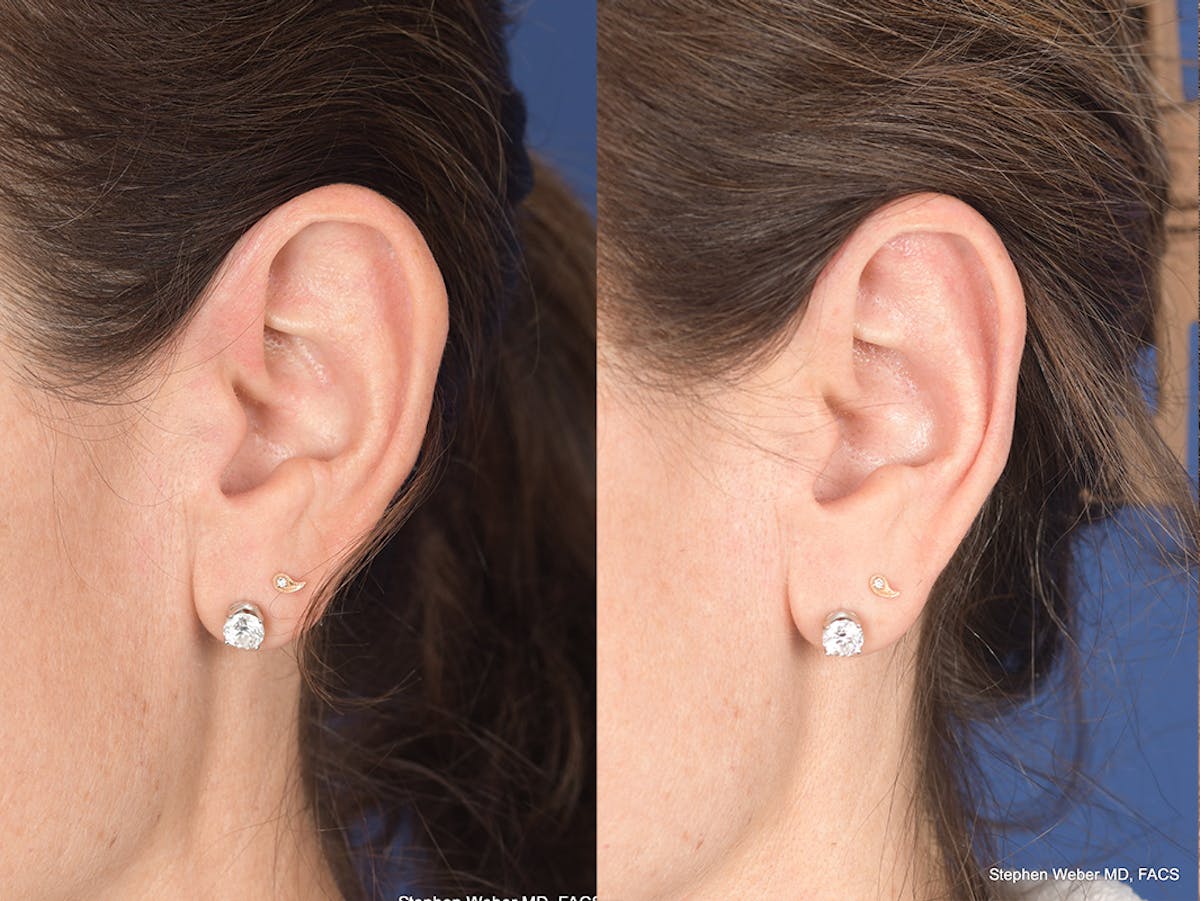 Otoplasty Before & After Gallery - Patient 315687 - Image 3