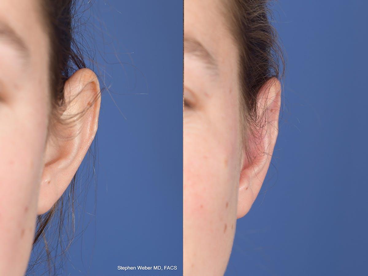 Otoplasty Before & After Gallery - Patient 703118 - Image 1