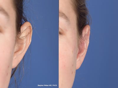 Otoplasty Before & After Gallery - Patient 703118 - Image 1