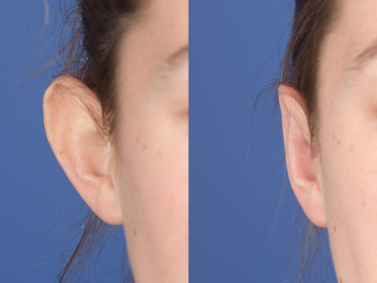 Otoplasty Before & After Gallery - Patient 703118 - Image 2