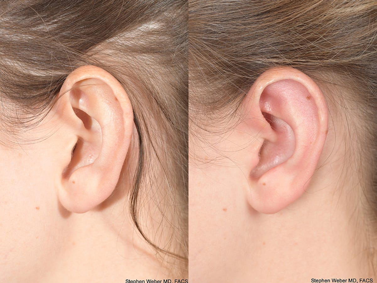 Otoplasty Before & After Gallery - Patient 703118 - Image 3