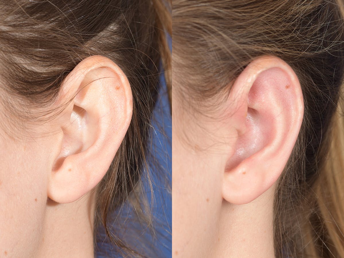 Otoplasty Before & After Gallery - Patient 703118 - Image 4