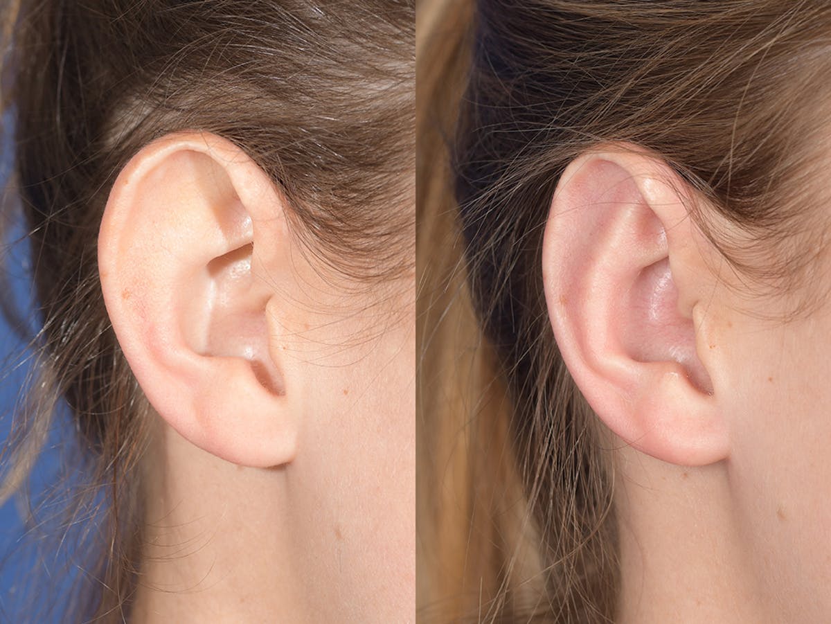 Otoplasty Before & After Gallery - Patient 703118 - Image 5
