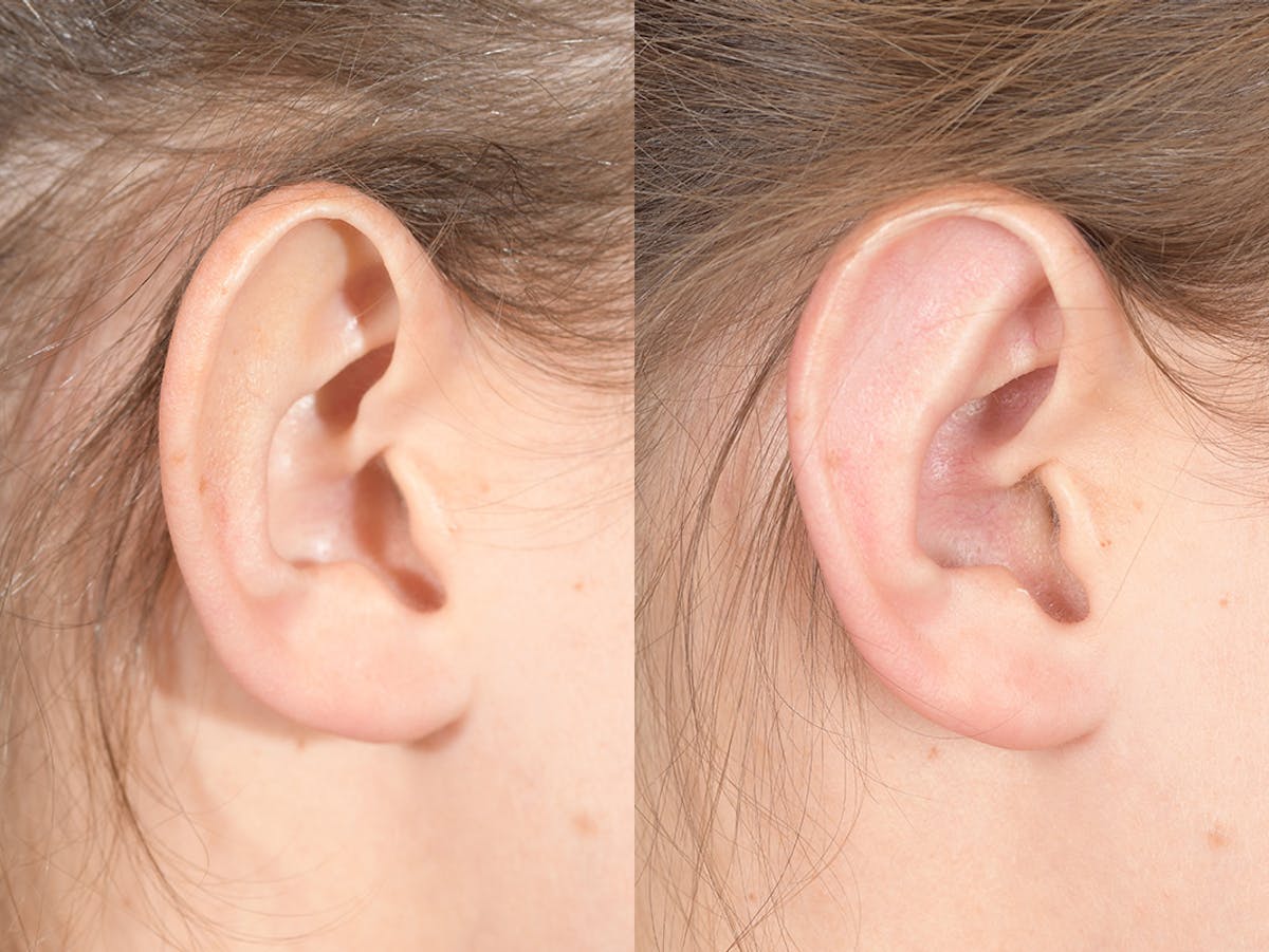 Otoplasty Before & After Gallery - Patient 703118 - Image 6