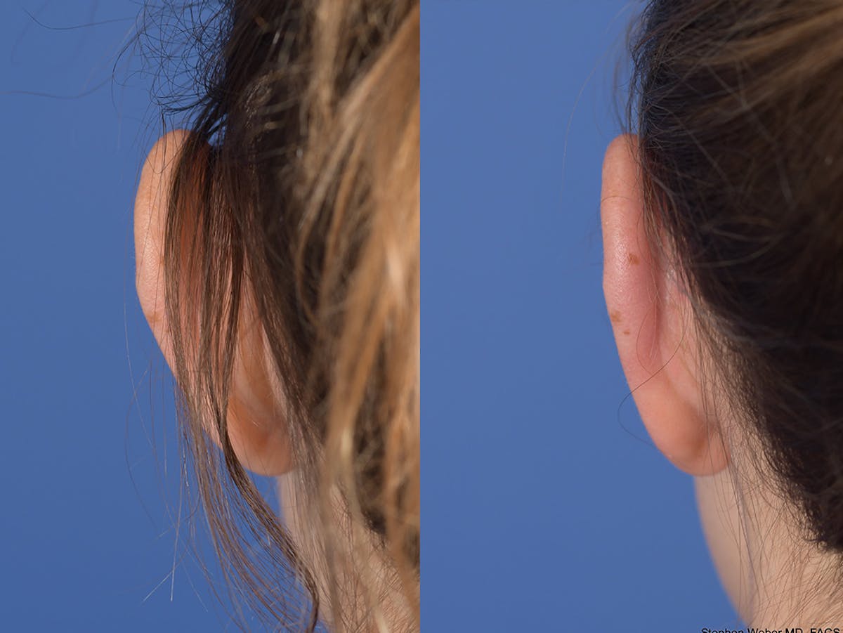 Otoplasty Before & After Gallery - Patient 703118 - Image 7