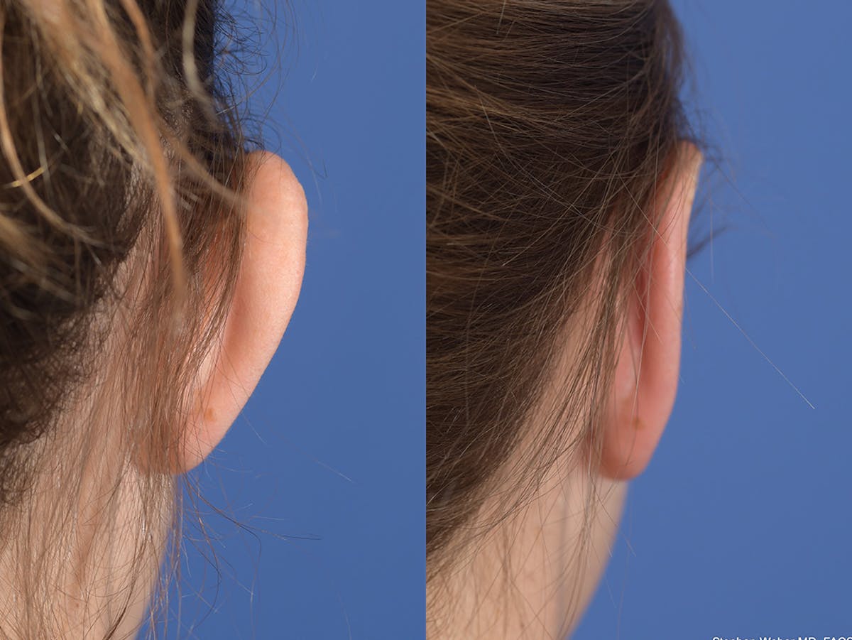 Otoplasty Before & After Gallery - Patient 703118 - Image 8