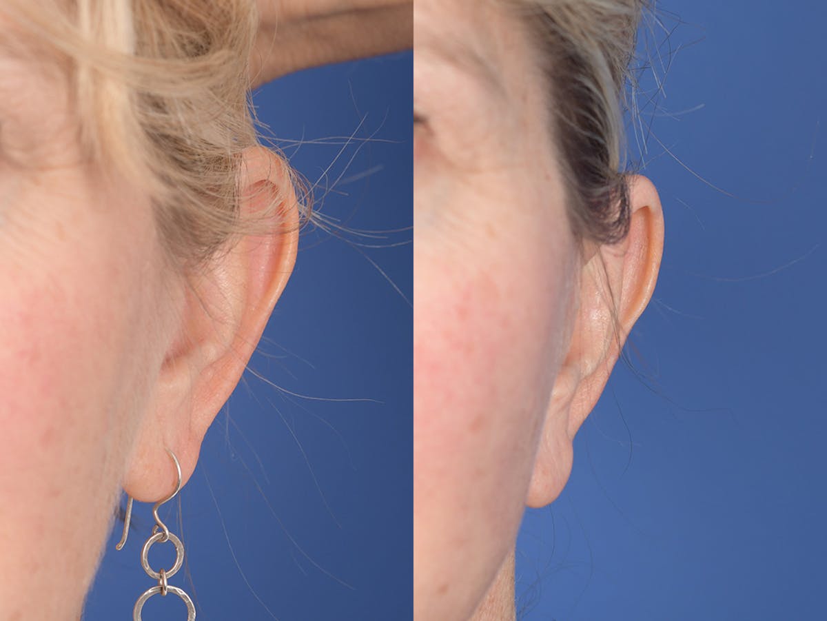 Otoplasty Before & After Gallery - Patient 418383 - Image 1