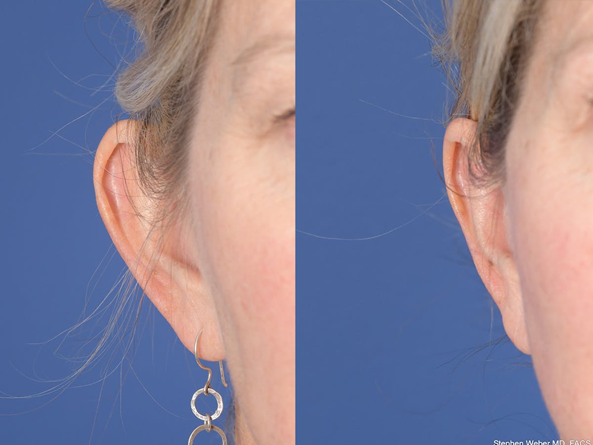 Otoplasty Before & After Gallery - Patient 418383 - Image 2
