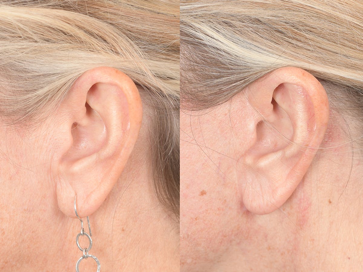 Otoplasty Before & After Gallery - Patient 418383 - Image 3
