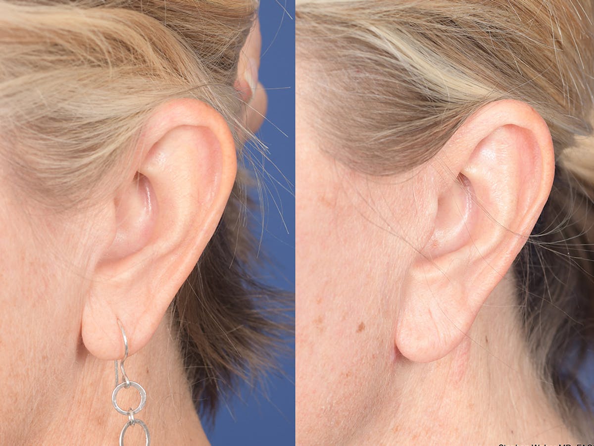 Otoplasty Before & After Gallery - Patient 418383 - Image 4