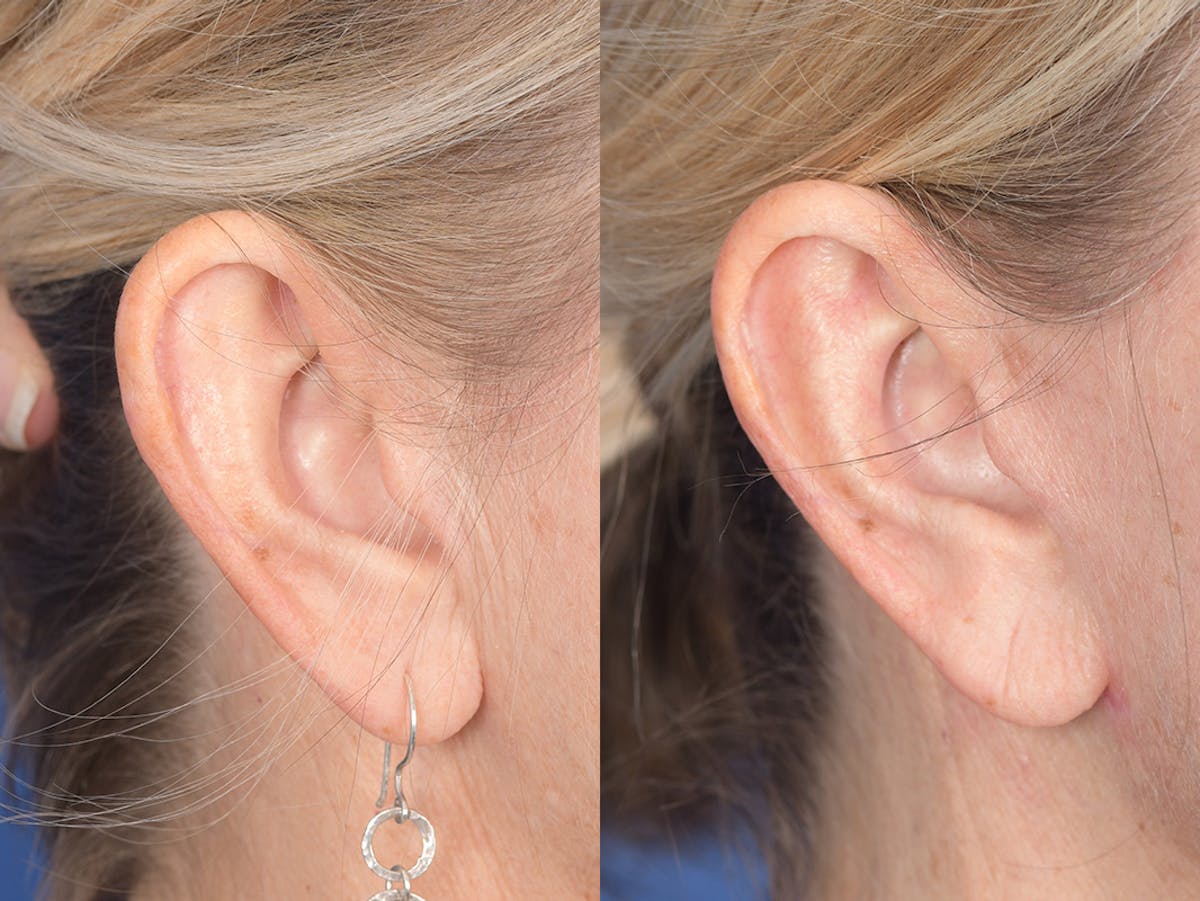 Otoplasty Before & After Gallery - Patient 418383 - Image 5