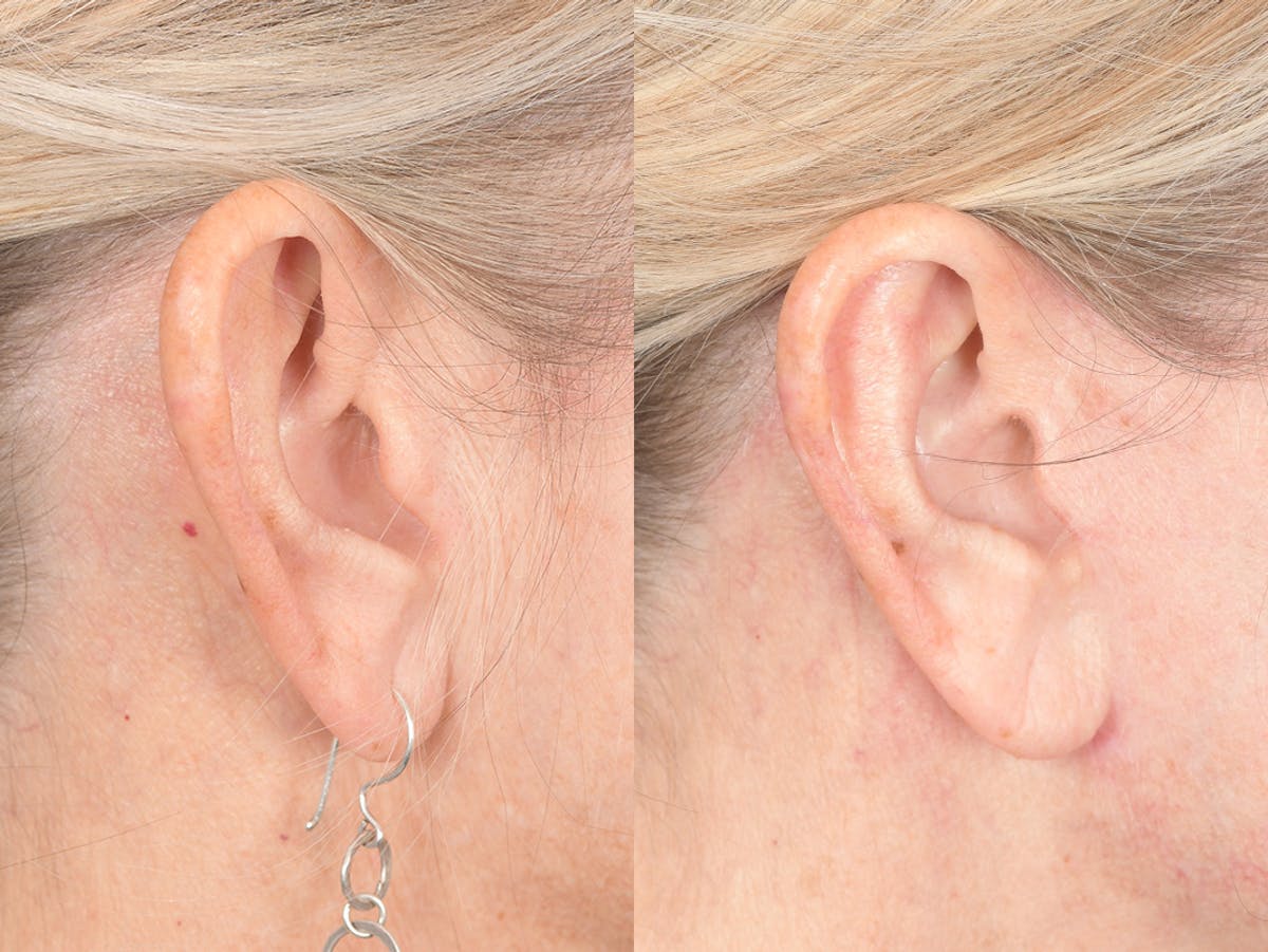 Otoplasty Before & After Gallery - Patient 418383 - Image 6