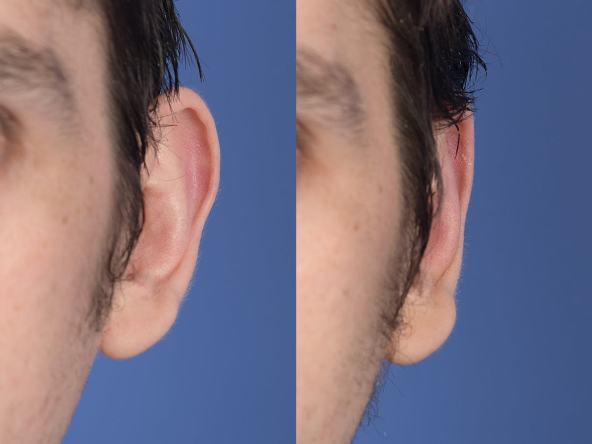 Otoplasty Before & After Gallery - Patient 261334 - Image 1