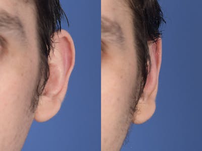 Otoplasty Before & After Gallery - Patient 261334 - Image 1