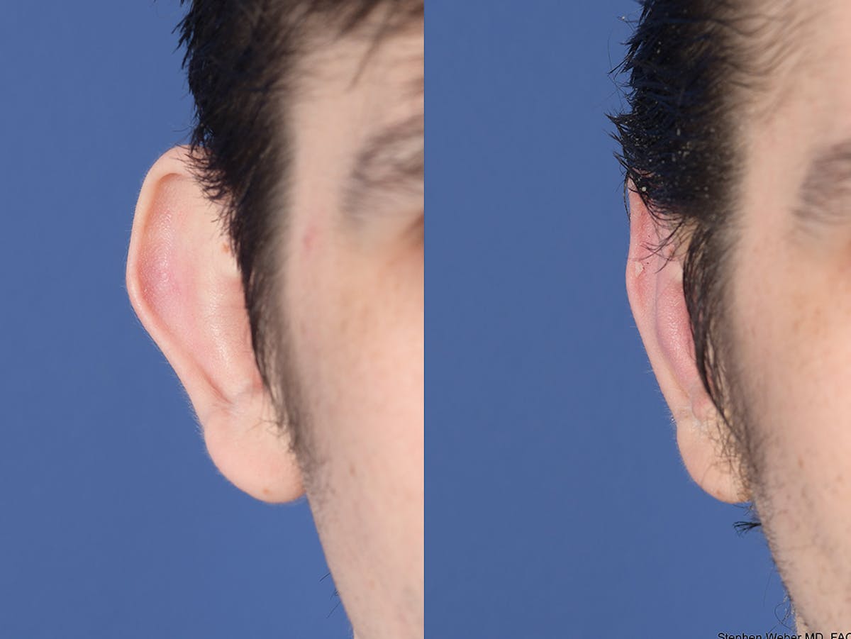 Otoplasty Before & After Gallery - Patient 261334 - Image 2
