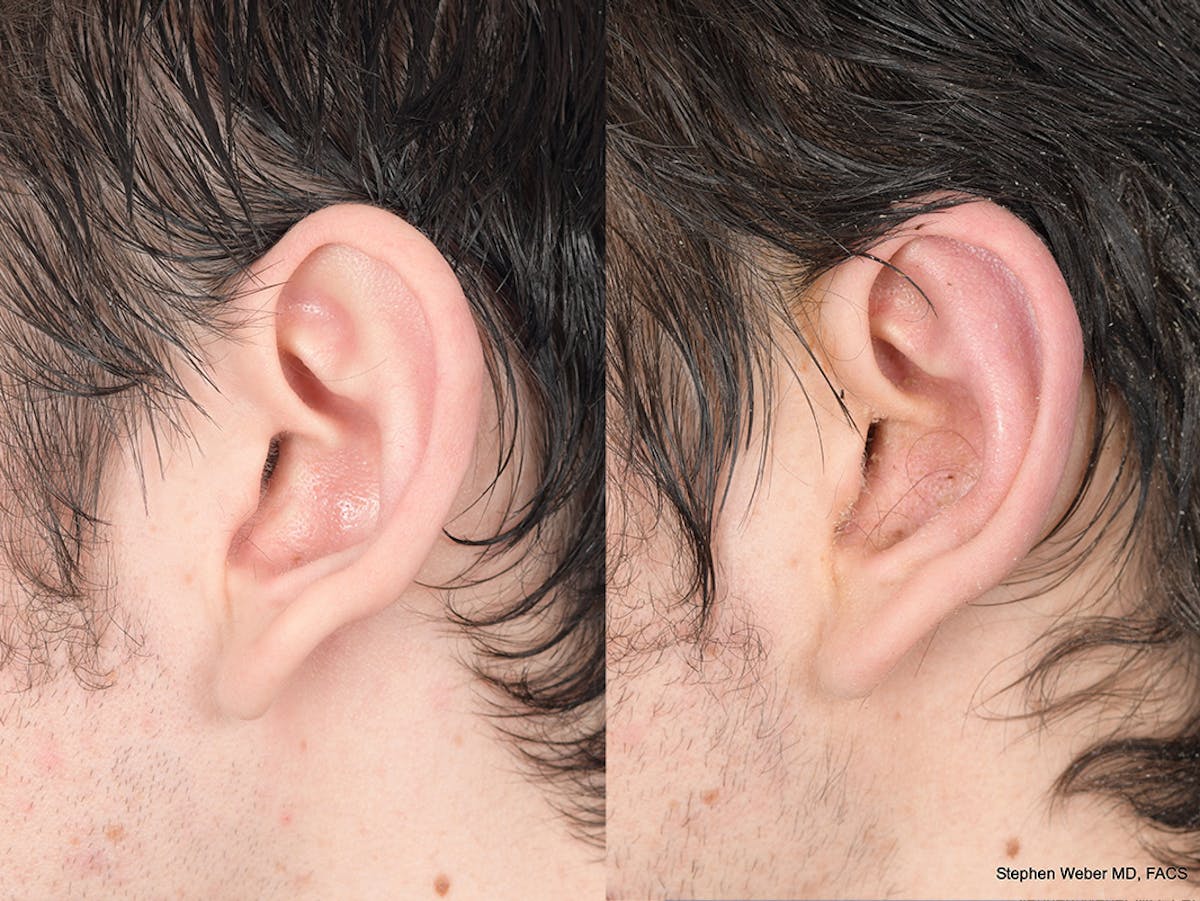 Otoplasty Before & After Gallery - Patient 261334 - Image 3