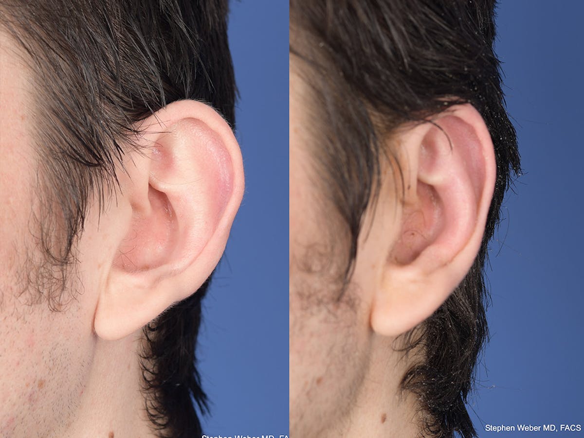 Otoplasty Before & After Gallery - Patient 261334 - Image 4