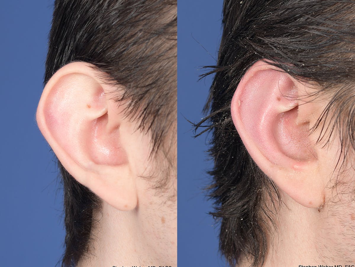 Otoplasty Before & After Gallery - Patient 261334 - Image 5