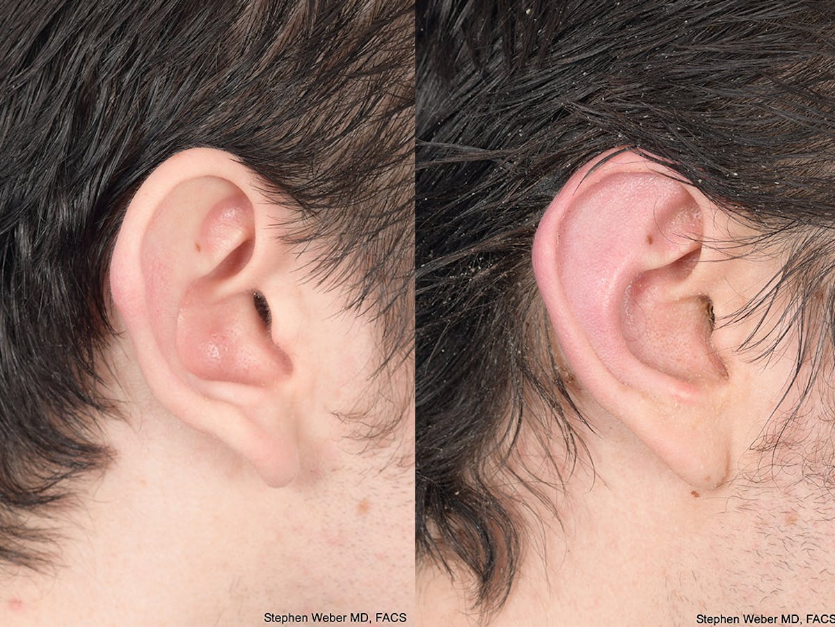 Otoplasty Before & After Gallery - Patient 261334 - Image 6