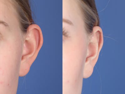 Otoplasty Before & After Gallery - Patient 382900 - Image 1