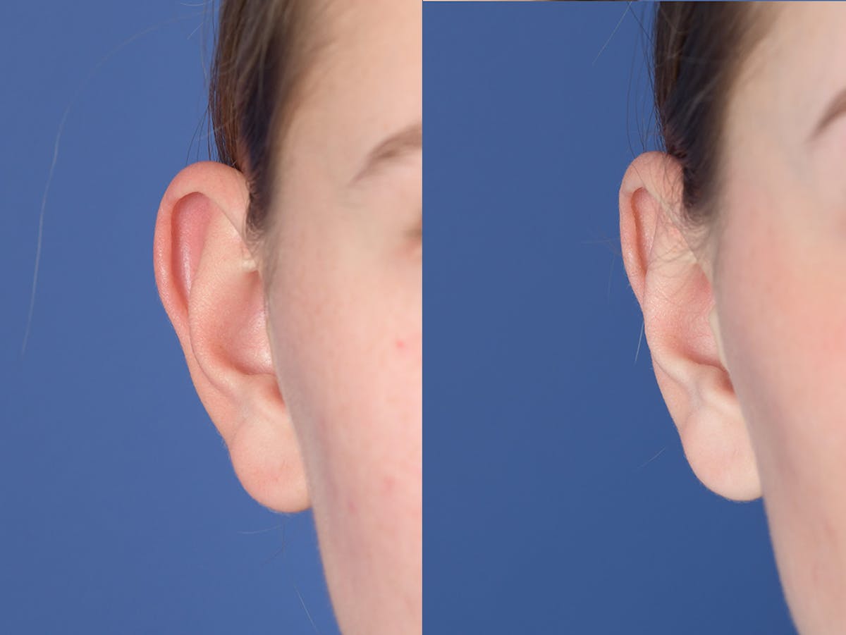 Otoplasty Before & After Gallery - Patient 382900 - Image 2