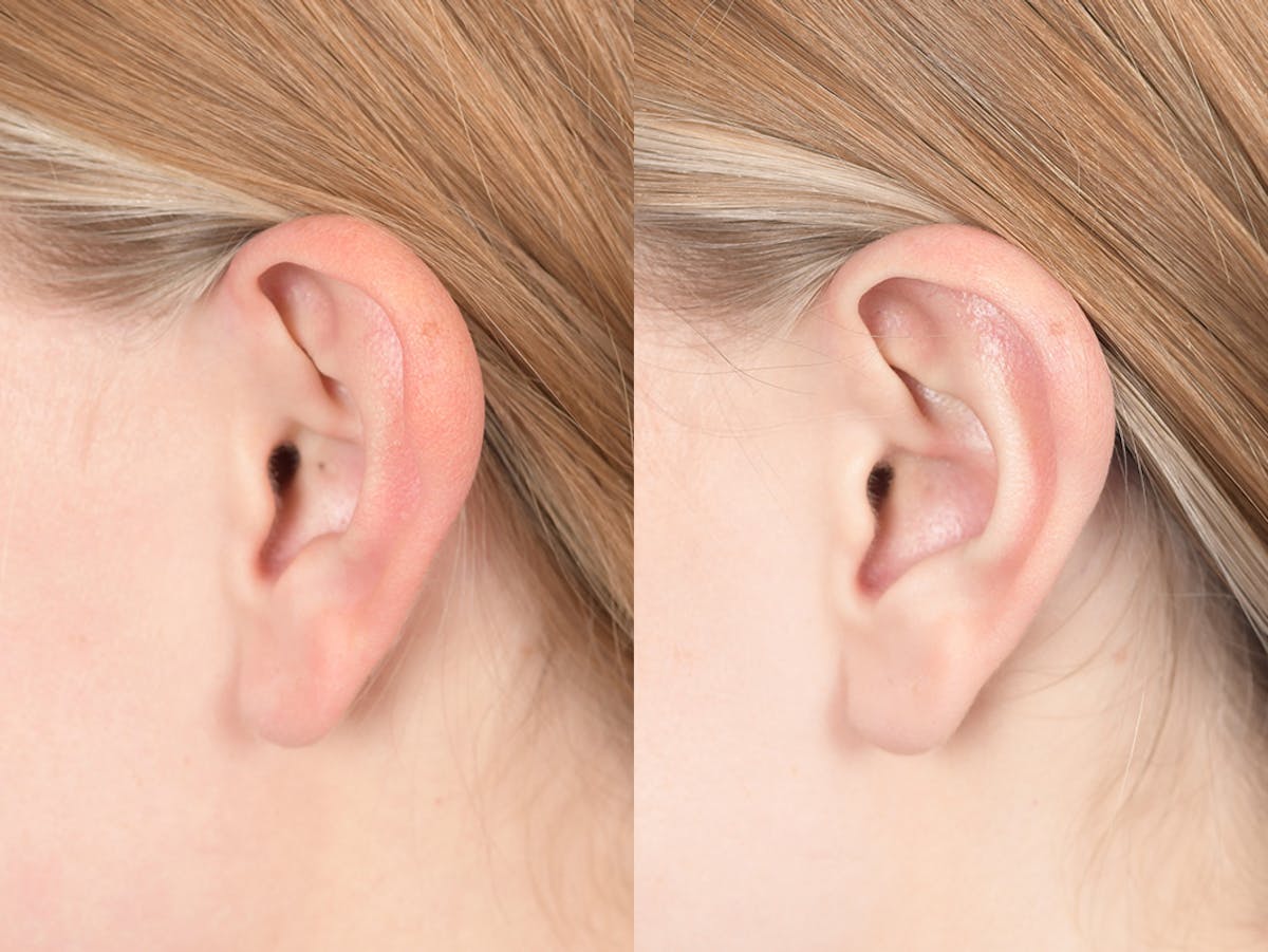 Otoplasty Before & After Gallery - Patient 382900 - Image 3