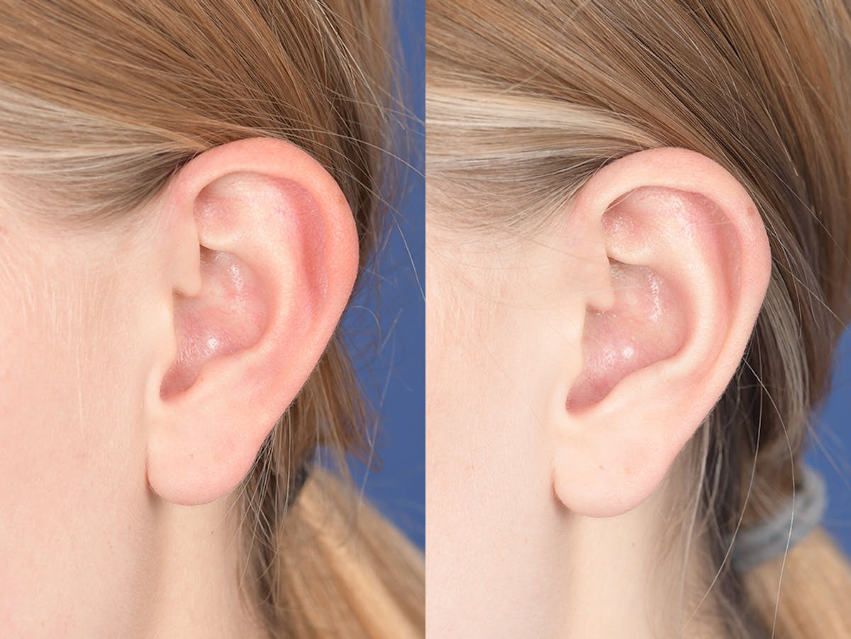 Otoplasty Before & After Gallery - Patient 382900 - Image 4