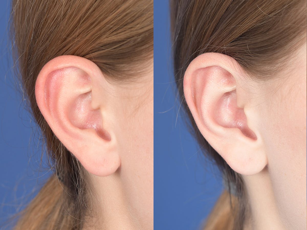 Otoplasty Before & After Gallery - Patient 382900 - Image 5