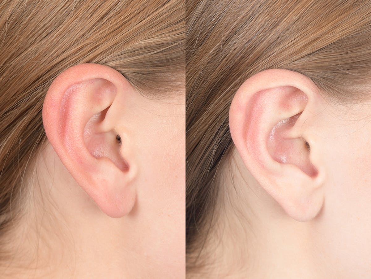 Otoplasty Before & After Gallery - Patient 382900 - Image 6