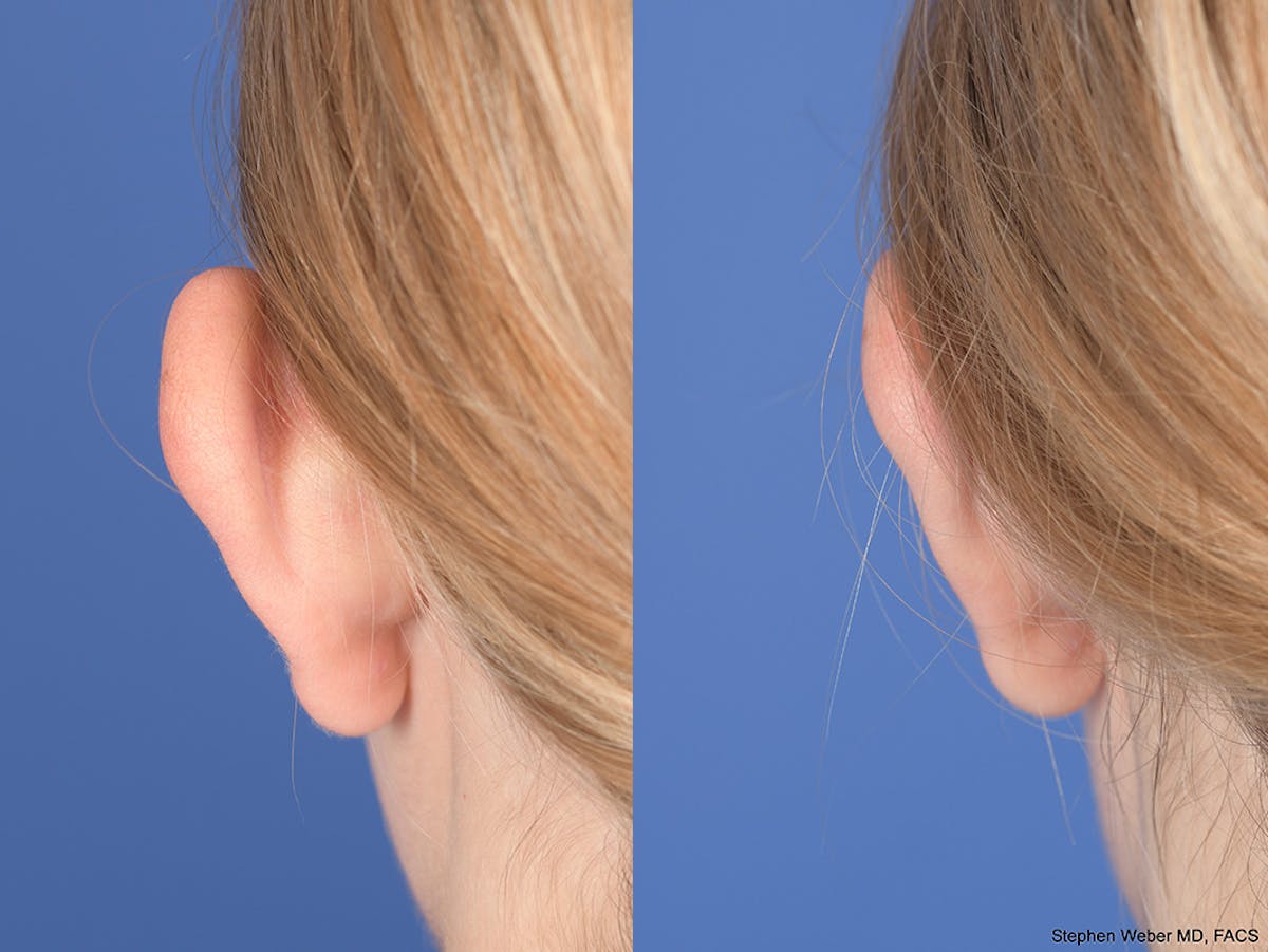 Otoplasty Before & After Gallery - Patient 382900 - Image 7