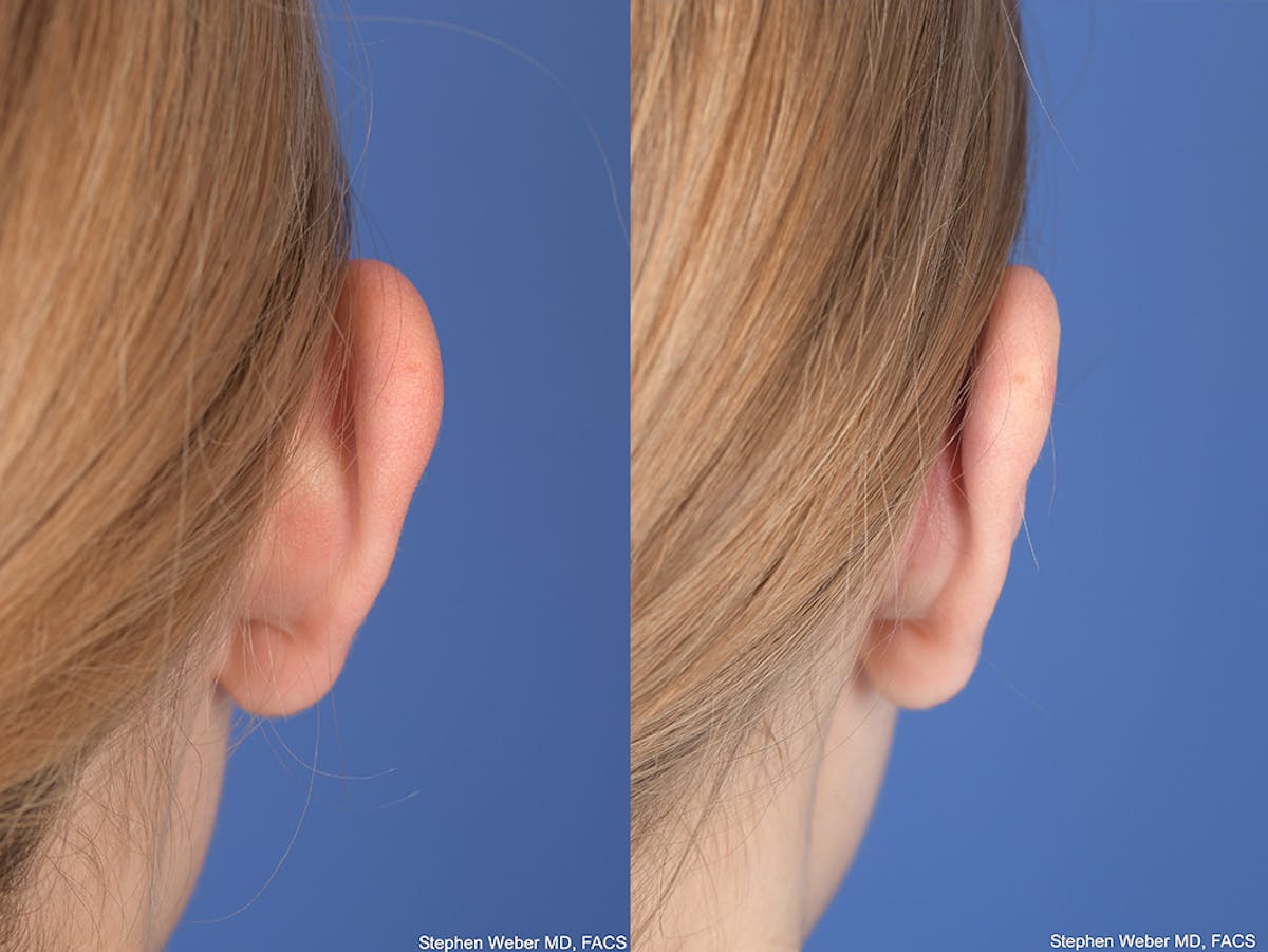 Otoplasty Before & After Gallery - Patient 382900 - Image 8