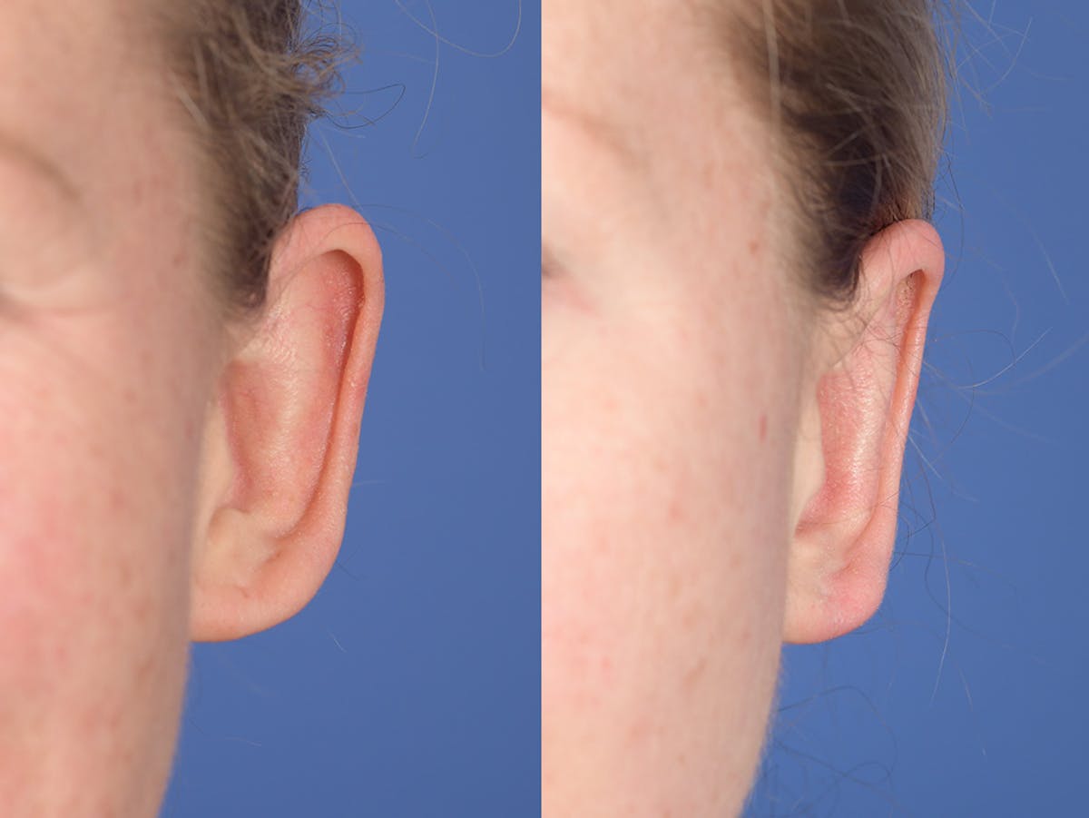 Otoplasty Before & After Gallery - Patient 303539 - Image 1