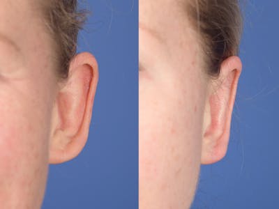 Otoplasty Before & After Gallery - Patient 303539 - Image 1