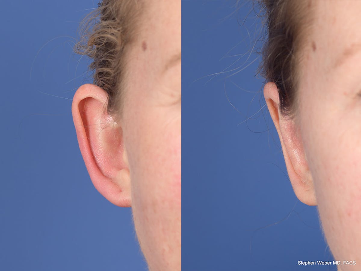 Otoplasty Before & After Gallery - Patient 303539 - Image 2