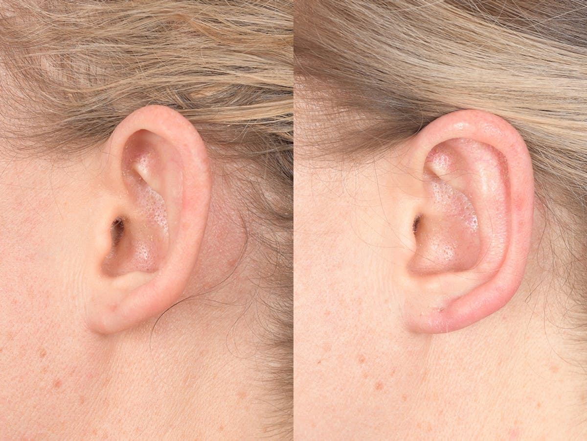 Otoplasty Before & After Gallery - Patient 303539 - Image 3