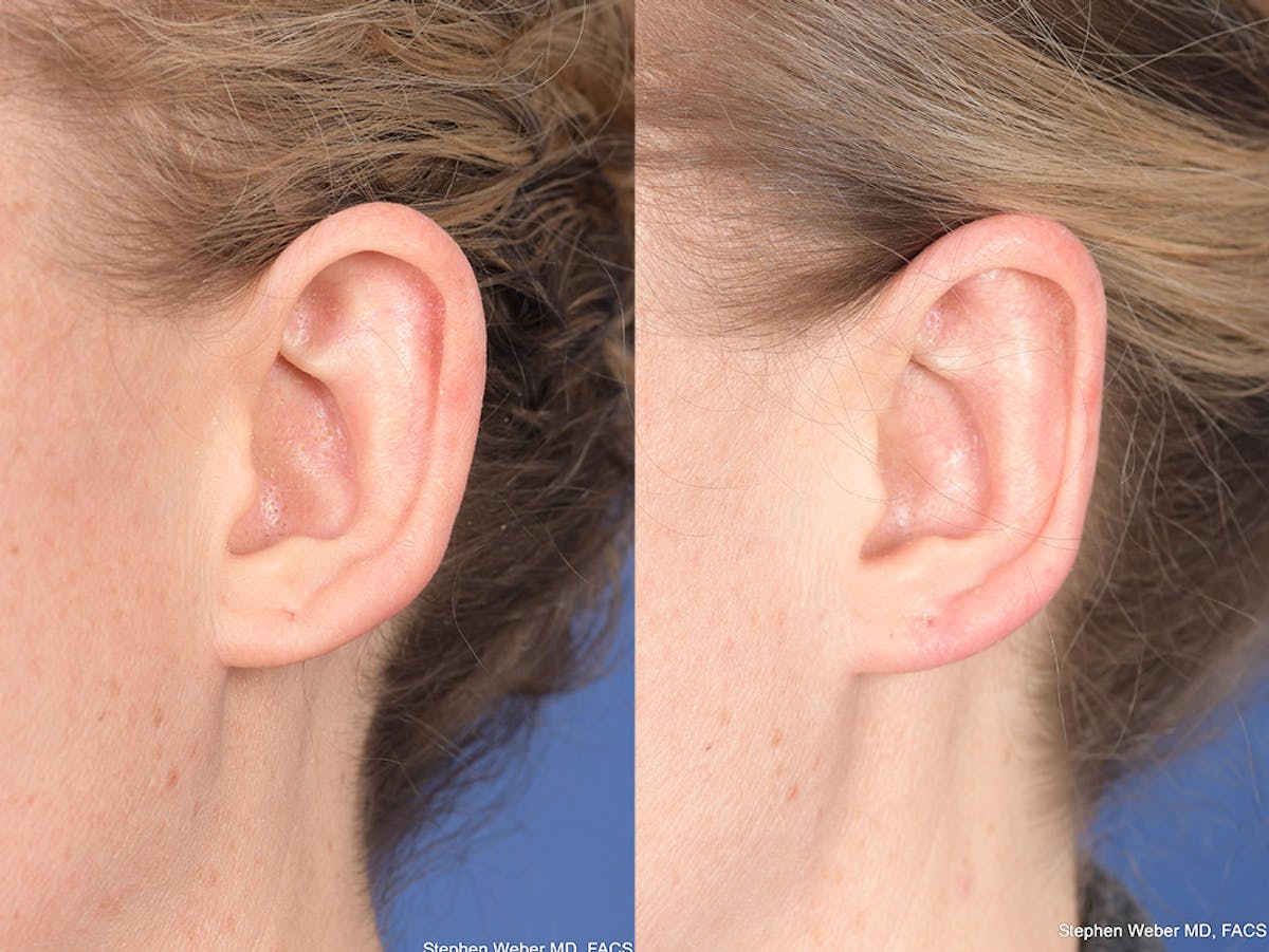 Otoplasty Before & After Gallery - Patient 303539 - Image 4