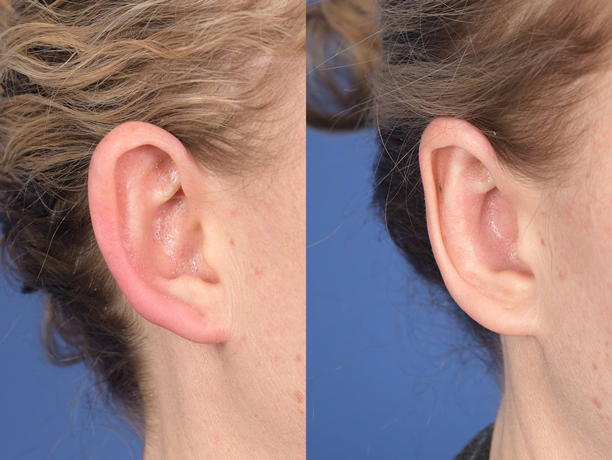Otoplasty Before & After Gallery - Patient 303539 - Image 5