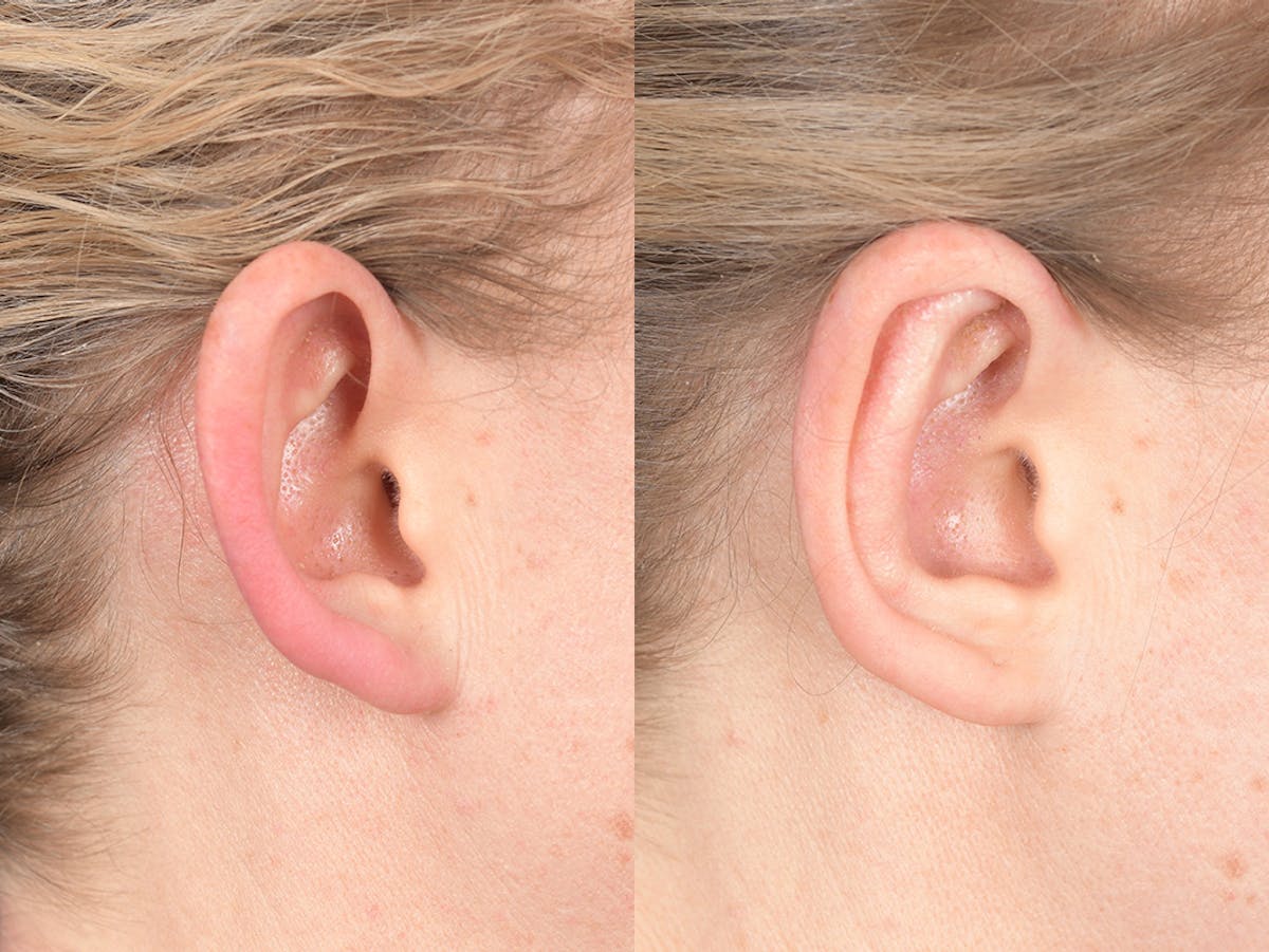 Otoplasty Before & After Gallery - Patient 303539 - Image 6