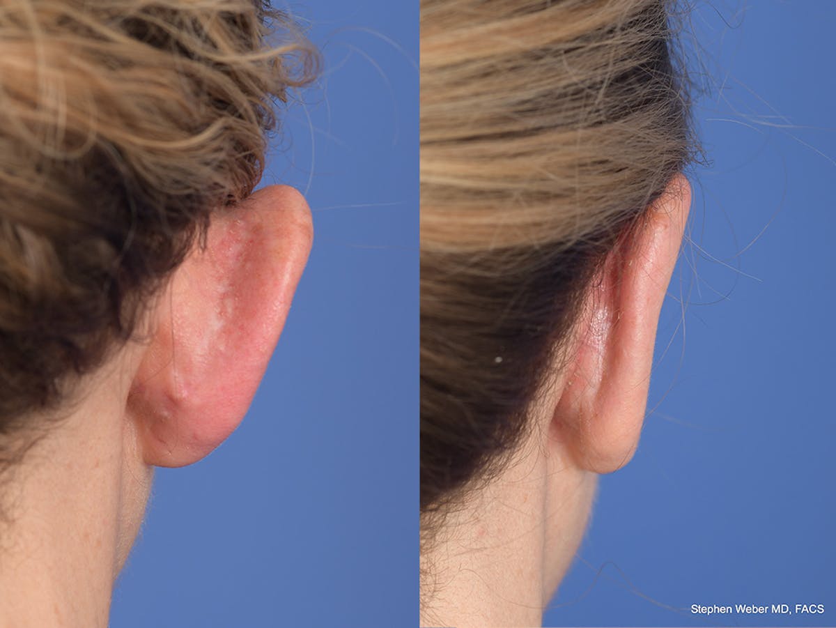 Otoplasty Before & After Gallery - Patient 303539 - Image 7