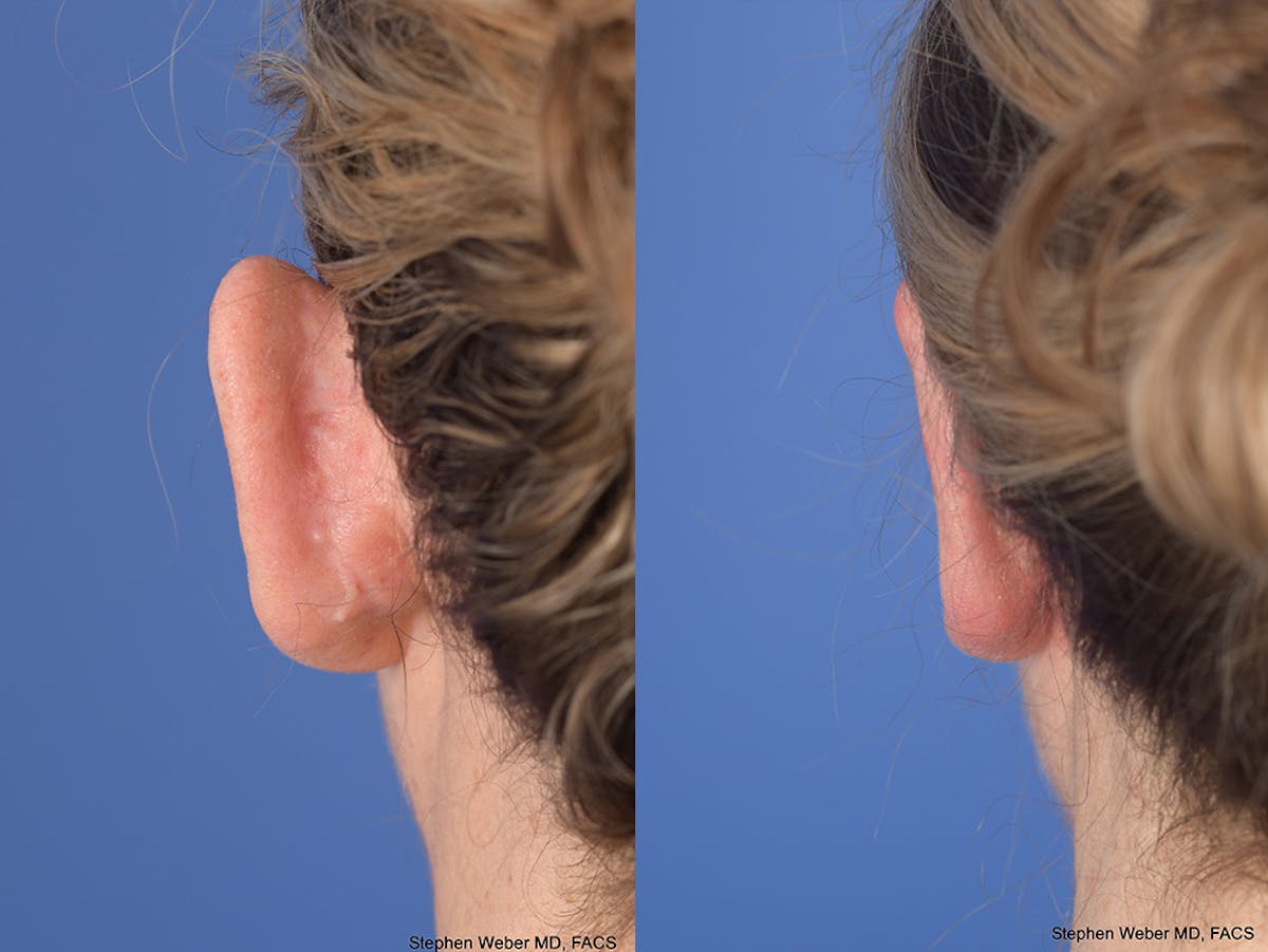Otoplasty Before & After Gallery - Patient 303539 - Image 8