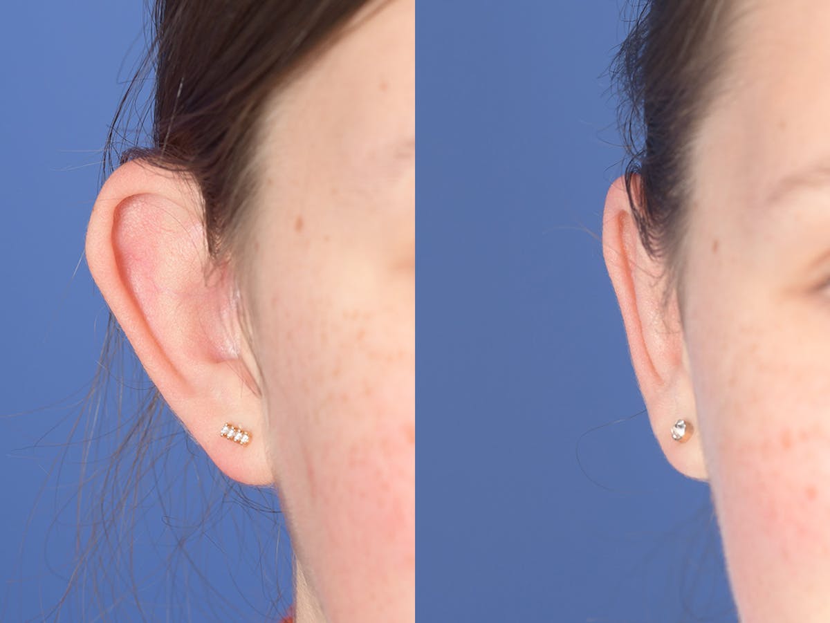 Otoplasty Before & After Gallery - Patient 333603 - Image 1