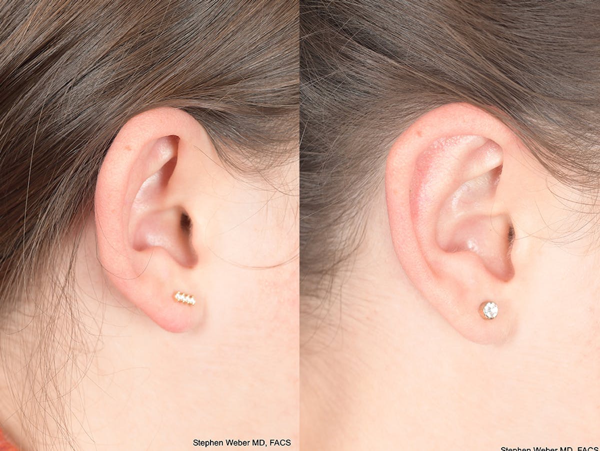 Otoplasty Before & After Gallery - Patient 333603 - Image 2