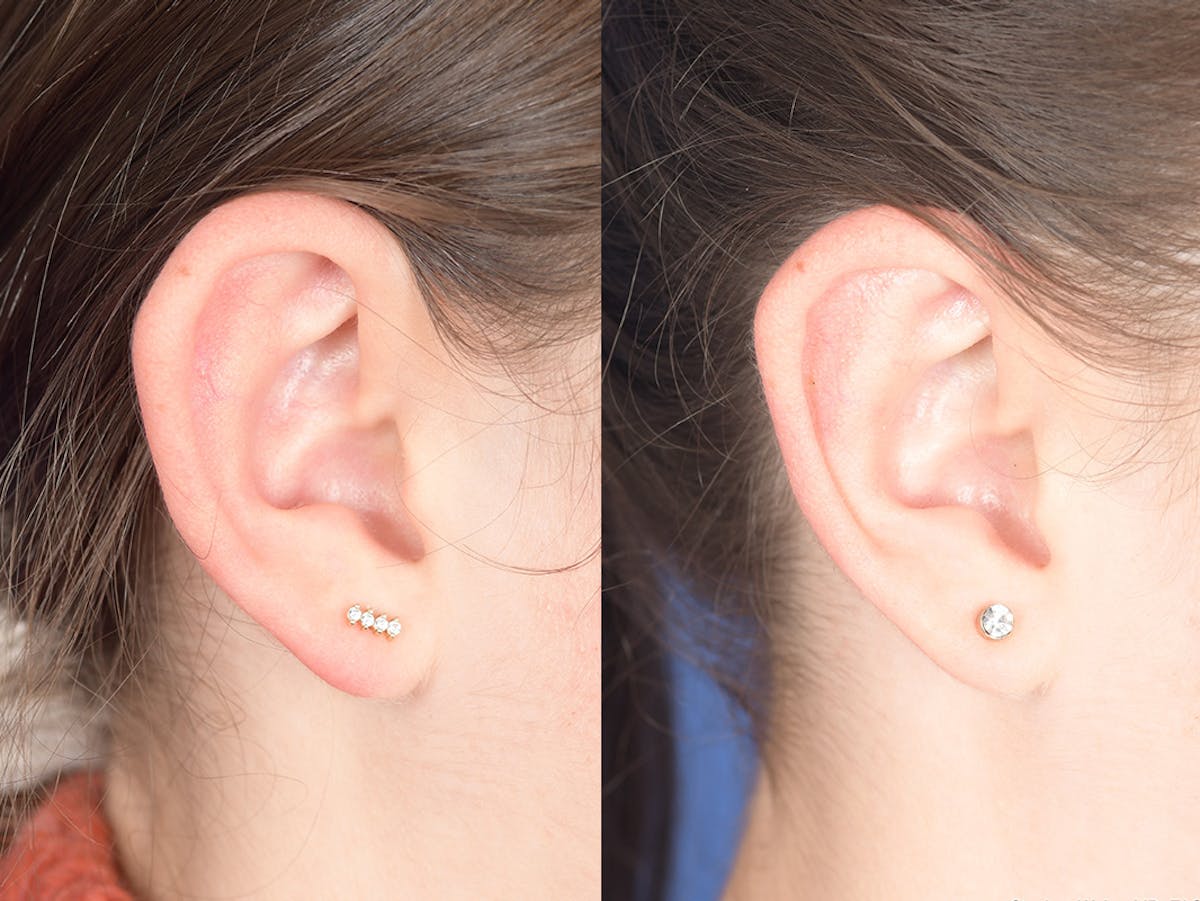 Otoplasty Before & After Gallery - Patient 333603 - Image 3