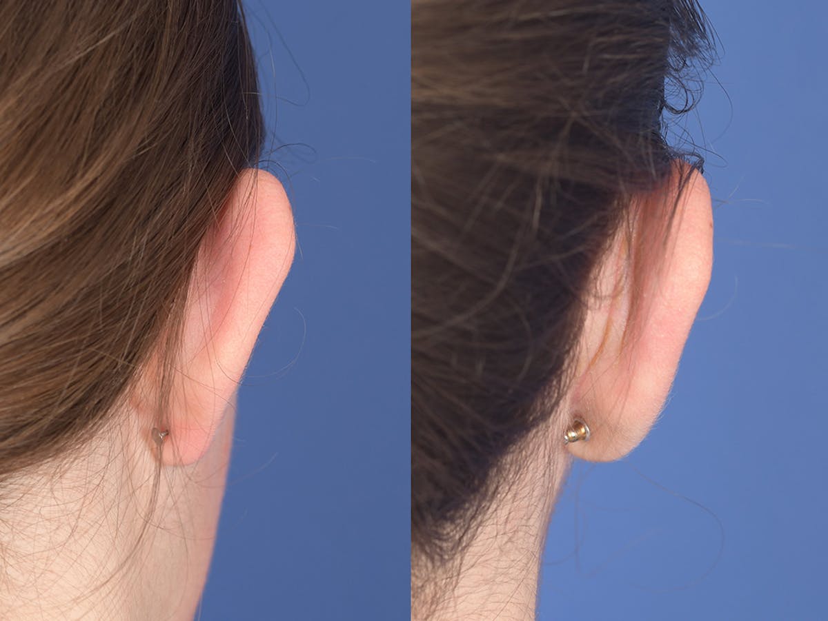Otoplasty Before & After Gallery - Patient 333603 - Image 4