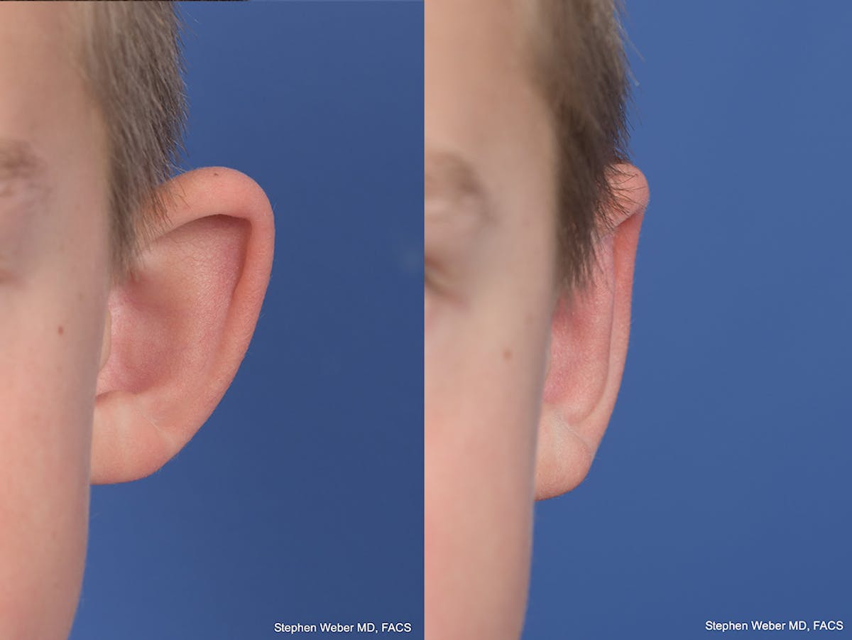 Otoplasty Before & After Gallery - Patient 145010 - Image 1