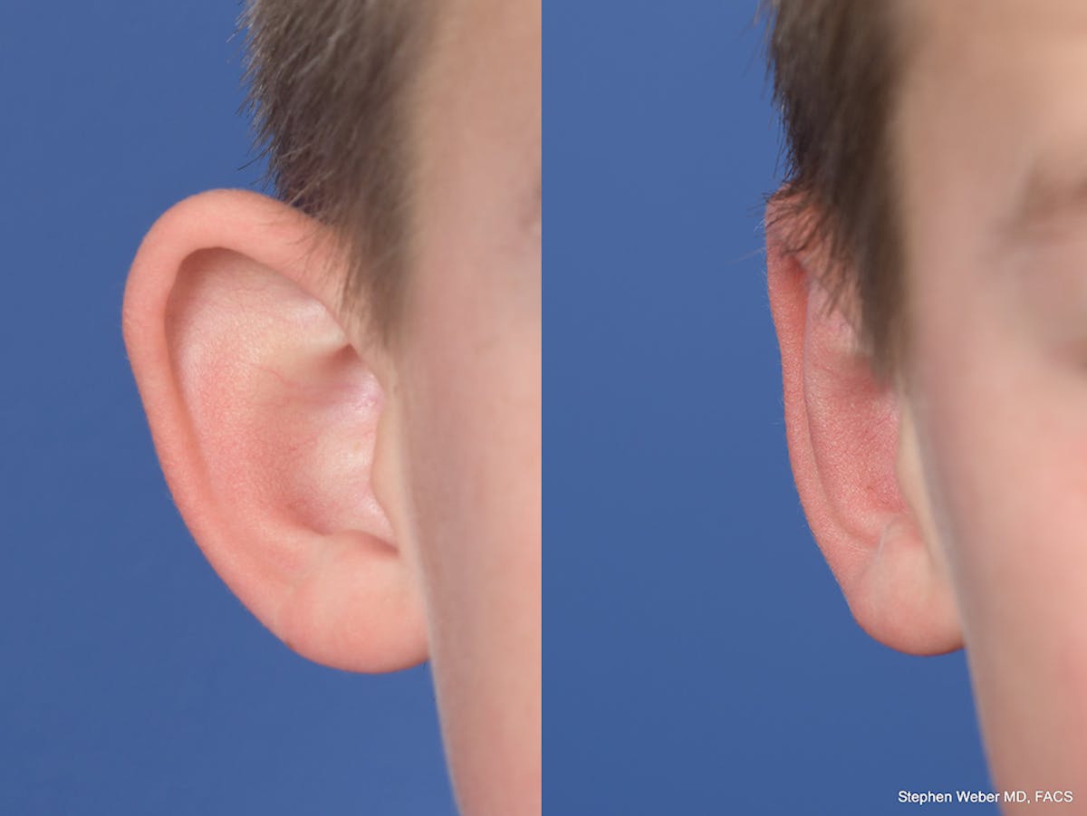 Otoplasty Before & After Gallery - Patient 145010 - Image 2