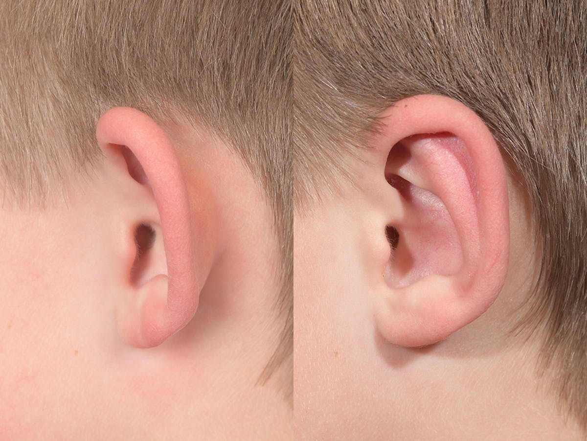 Otoplasty Before & After Gallery - Patient 145010 - Image 3